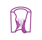 ENFERMEDAD HEMORROIDAL